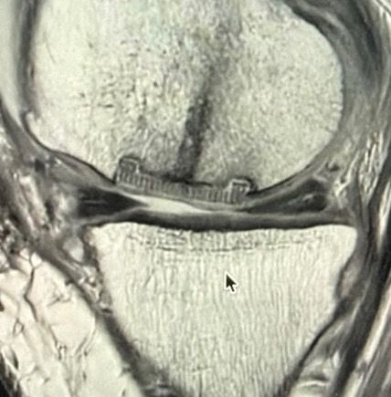 MRI showing the Nanochon Chondrograft implant in the knee